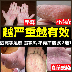 syneo水耐企业店淘宝治手裂的药膏脚后跟干裂粗糙鹅掌风手脱皮手指