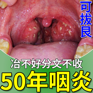 咽喉炎慢性咽炎除根喉咙卡痰嗓子有异物感治疗痒干咳嗽特效专用药