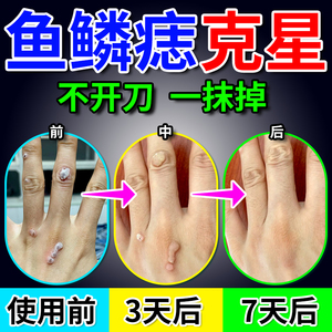 鱼鳞痣药膏扁皮疣点疣手指长疣石疣趾疣去除膏疣瘊克星拓疣专用药