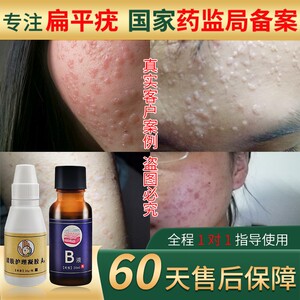 扁平疣药膏