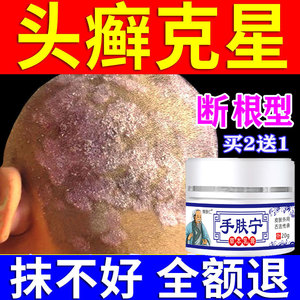 头藓药膏头癣