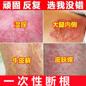 湿疹止痒去根股癣药膏男女私处大腿内侧阴囊体股藓皮肤瘙痒外用药