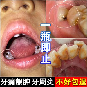 治牙疼牙痛特效成人儿童上火喷雾蛀虫喷剂消炎水智齿神经牙龈肿痛