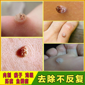 祛刺猴去除正品瘊子修子药去猴子肉粒疙瘩治鱼鳞痣肉刺专用药神器