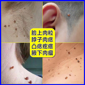 去除脖子上长小肉粒疙瘩猴子皮赘神器丝状疣颈部瘤一抹无忧专用药