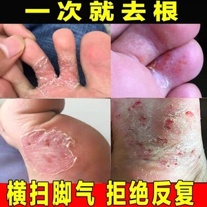 005人付款淘宝脚轻松治脚气喷剂水泡去根止痒脱皮脚臭脚气脚出汗神器