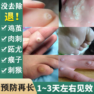 祛刺瘊子去除神器肉粒疙瘩手上长鱼鳞痣肉刺猴子跖疣专用膏去根