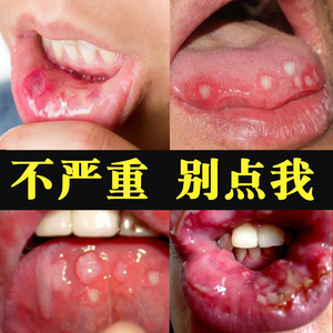 口腔溃疡喷剂