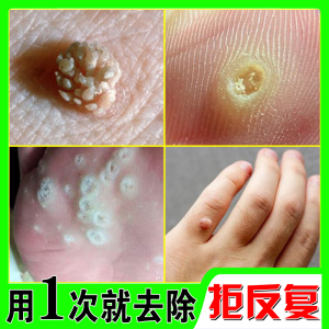 去猴子肉粒疙瘩刺猴去除正品鱼鳞痣非药祛瘊子神器脚手足部肉刺膏