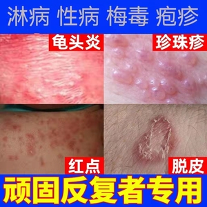 治疗淋病性病一扫光包皮炎龟头炎梅毒男女性病克星喷剂私处药膏