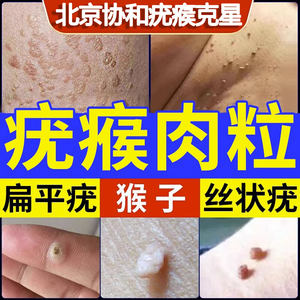 去疣药膏去脖子上长小肉粒除丝状扁平疣瘊子祛猴子疙瘩尤瘊克疣膏