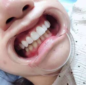 义获嘉瓷贴面粘接基质xlbase基底胶漂白色全瓷冠嵌体粘接基础剂剂