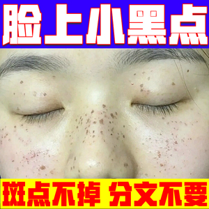 去脸上小黑点除中老年黑班苍蝇屎长斑怎么办专用药点斑儿童祛斑霜