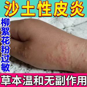 沙土皮炎柳絮花粉过敏药膏湿疹止痒去根顽固皮炎全身神经性日光性