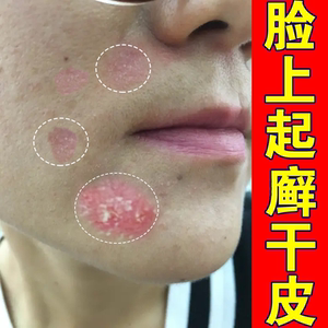 脸上起癬长癬【无效包退】眼皮癬过敏脸干燥起皮脱皮干皮保湿药膏