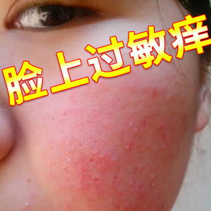 同款货源广盛隆大药房旗舰店天猫rx新霉素氟轻松乳膏脸部过敏性