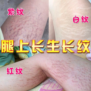 消除腿上有去肥胖纹生长纹大腿学生肥月半纹去除男修复霜祛妊娠纹
