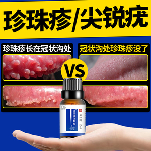 龟頭珍珠状丘珍假性尖锐湿疣鬼臼毒素酊冠状沟珍珠粒疹去除克优净
