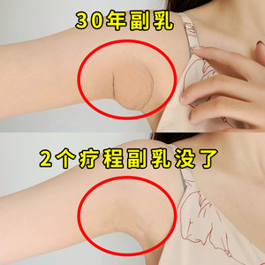 副乳消除神器贴收副乳
