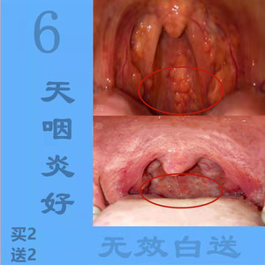 咽喉炎喷剂慢性咽炎肿痛滤泡增生喉咙异物感嗓子疼茶蜂胶雾化喷剂