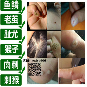 去脚刺猴子膏特效-淘宝拼多多热销去脚刺猴子膏特效