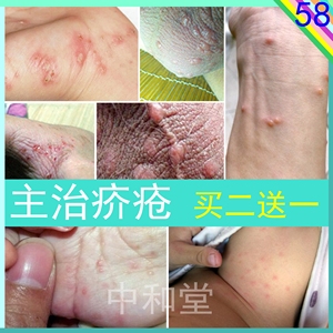 疥疮膏去除疥疮结节股藓阴囊私处皮肤瘙痒水泡湿疹红疹男女外用药