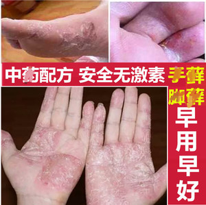 治顽固性手癣膏脱皮脚癣真菌手足藓皮肤病外用止痒膏湿疹止痒去根