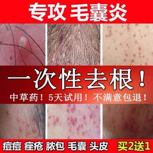 马拉色菌毛囊糠秕孢子菌疙瘩毛囊炎脂溢性皮炎头皮头部脓包疮药膏