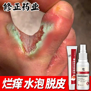 脚气脱皮止痒杀菌去烂脚丫脚趾缝糜烂烂痒根神器治脚痒水泡非药膏