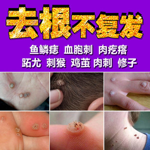 祛疣体治猴子刺猴药点鱼鳞痣贴肉刺去除膏瘊疣净修子鸡眼膏药灵疗