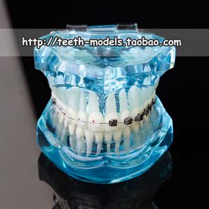 普通牙套托槽图片_普通牙套托槽图片_无托槽牙套