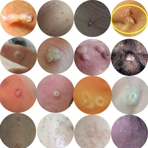 周氏去瘊灵膏去除猴子鸡眼膏贴跖尤刺侯丝状尤老茧脚垫净鱼休子