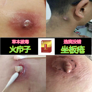 拔毒膏火疖子神器草本拔毒吸脓贴坐板疮肿硬块药拔脓膏正品外用