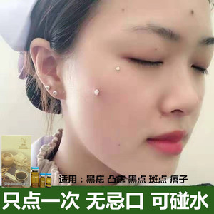 90百年张氏总店淘宝【祖传】点痣的药膏祛痣无痕正品点痦瘊子去黑痣