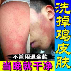 毛周角化症去鸡皮肤疙瘩儿童毛孔堵塞修复脸部橘皮马拉色菌沐浴露