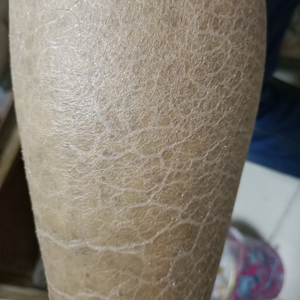 鱼鳞蛇皮肤霜去除修护滋润腿部干燥起脱皮秋冬手臂全身补水光滑治