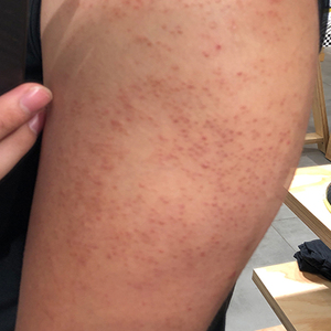 毛周角化维a酸乳膏腿部去鸡皮肤毛囊手臂祛除膏疙瘩霜干燥堵塞症