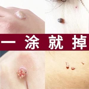 去脖子上的小肉粒祛刺瘊子痦子去猴子肉痣凸痣专用药正品去除神器