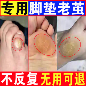 去脚底厚老茧死皮软化剂祛脚垫脚趾头手足部关节茧子去除专用神器