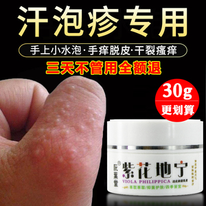 湿疹皮肤专用治汗疱疹药膏手痒脱皮手上起小水泡止痒去根真菌感染