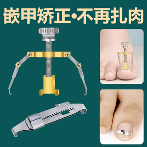 嵌甲矫正器正甲扣甲沟炎软化甲指甲扎肉专用修复工具脚趾甲弯曲