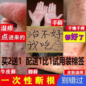 儿童湿疹止痒去根手上湿疹癣藓根除西1域毒癣灵胆碱能性荨麻疹