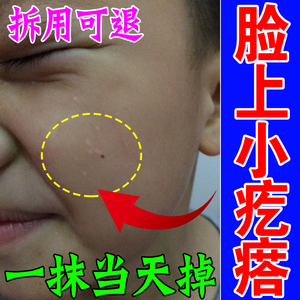 小孩脸上有小颗粒脂肪粒去除神器汗管瘤眼部毛囊炎药专用特效 膏