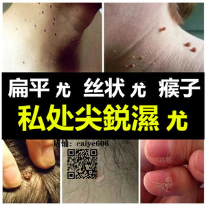克疣液克尤液扁平尤肉粒丝状尤肉刺瘊子去除脖子肉球克尤王消疣灵