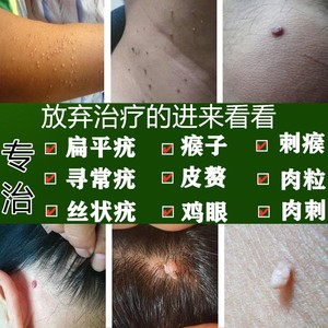 去除扁平疣面部颈部丝状疣脖子日本肉粒瘊子去疣净治疗药膏神器