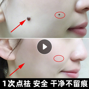 日本颜美宝脱痣膏修痣膏消痣灵※去黑痣 祛斑 去黑色素