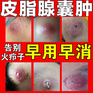 00103人付款淘宝火疖子拔毒膏痒疼痛消红肿疙瘩屁股疙瘩脓块流脓坐板
