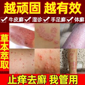 治疗牛皮屑的药治疗头皮屑的药牛皮癣喷剂硫磺药头皮真菌感染药膏