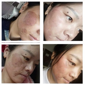 点斑皮秒反黑激光术后烫伤修复色素沉着氢醌苯二酚熊果苷美白提亮