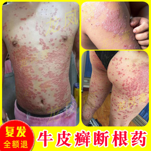 治疗牛皮藓癣药膏银屑病皮肤过敏瘙痒体股藓玫瑰糠疹草本中药乳膏